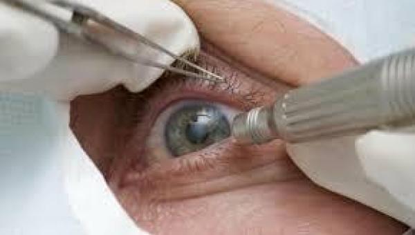 Mutirão de catarata já realizou 117 cirurgias e segue cronograma neste sábado em Gurupi 