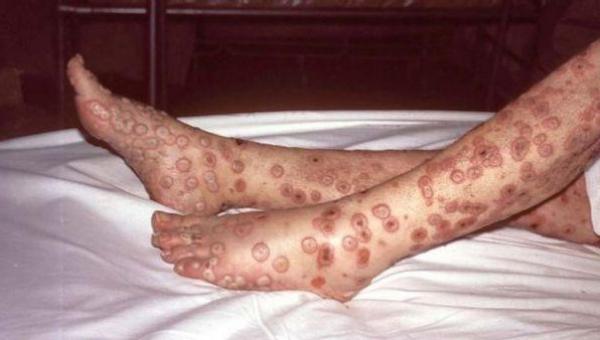 OMS admite que controle total da varíola do macaco é incerto
